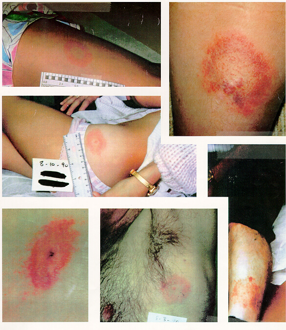 Pictures of Rashes